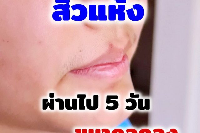 เมื่อลูกเข้าสู่วัยรุ่นและเริ่มเป็นสิว ใช้ ยารักษาสิว แบบไหนดี