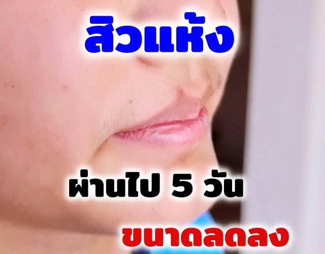 เมื่อลูกเข้าสู่วัยรุ่นและเริ่มเป็นสิว ใช้ ยารักษาสิว แบบไหนดี