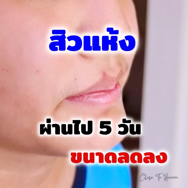 ยารักษาสิว แบบไหนดี เมื่อลูกเข้าสู่วัยรุ่น